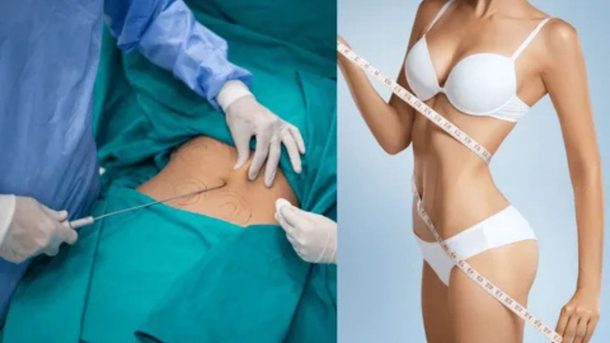 Best Liposuction Surgeon in Gurgaon – Achieve Safe and Natural Body Contouring with Expert Care